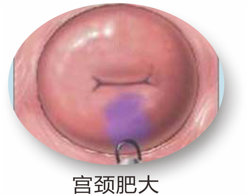 没生过孩子,重度宫颈糜烂一定要物理治疗或者手术治疗