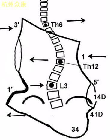 脊柱侧弯矫正示意图