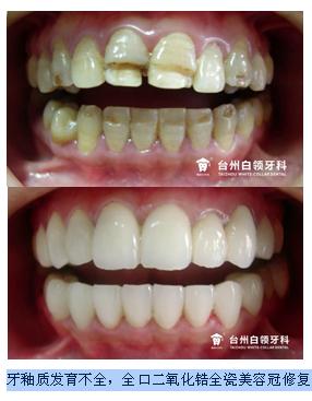 牙釉質發育不全，全口二氧化鋯全瓷美容冠修復