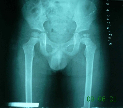 江某-儿童股骨头骨骺坏死症-治疗前