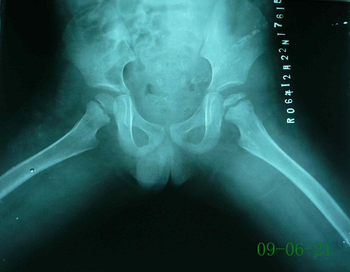 江某-儿童股骨头骨骺坏死症-治疗前蛙位