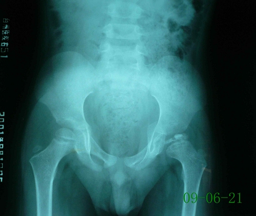 程某-儿童股骨头骨骺坏死症-治疗前