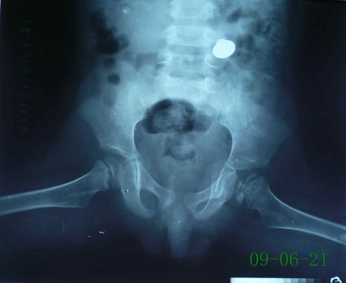 程某-儿童股骨头骨骺坏死症-治疗前蛙位