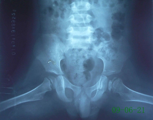 程某-儿童股骨头骨骺坏死症-治疗中蛙位