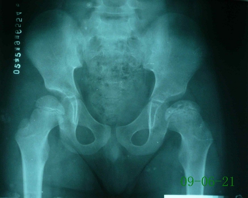 骆某-儿童股骨头骨骺坏死症-治疗后