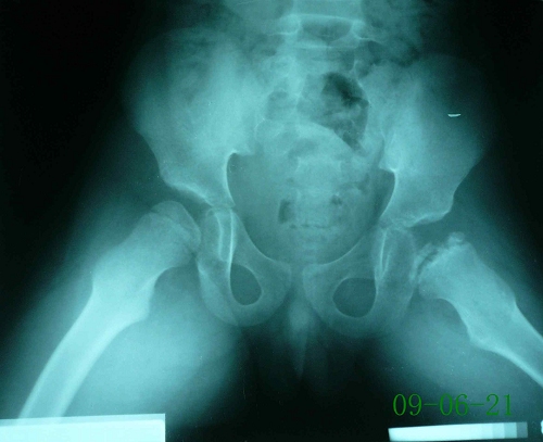 骆某-儿童股骨头骨骺坏死症-治疗前蛙位