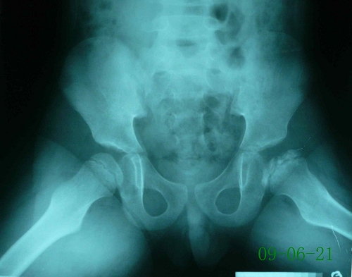 骆某-儿童股骨头骨骺坏死症-治疗中蛙位