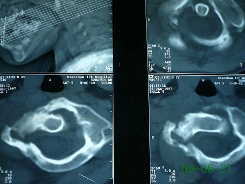 胡某-颈椎第1、2椎体原发性恶性骨肿瘤-治疗后1