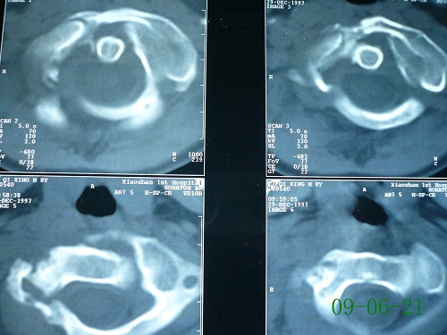 胡某-颈椎第1、2椎体原发性恶性骨肿瘤-治疗后2