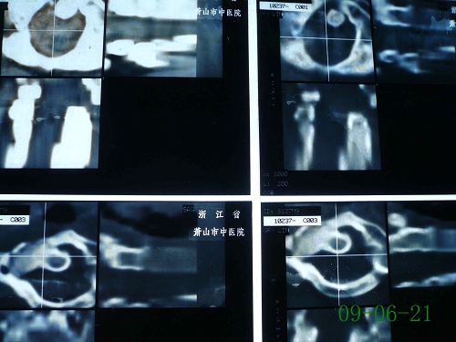胡某-颈椎第1、2椎体原发性恶性骨肿瘤-治疗后5