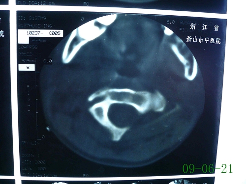 胡某-颈椎第1、2椎体原发性恶性骨肿瘤-治疗后9