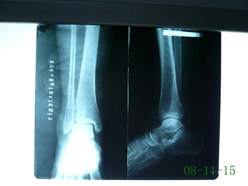 刘某-右外后踝骨折（三踝骨折）-术前