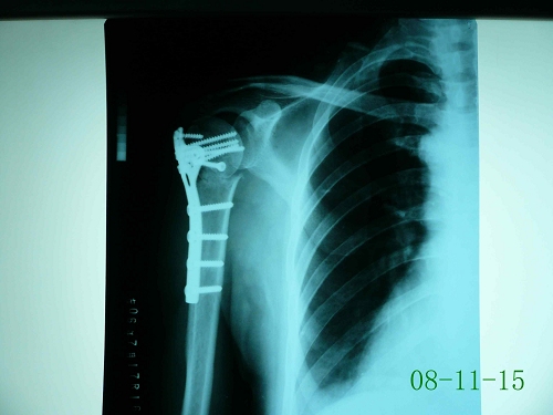 宋某-左肱骨外科颈骨折-术后1