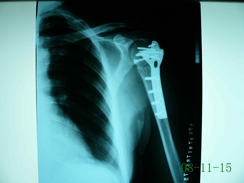 宋某-左肱骨外科颈骨折-术后2