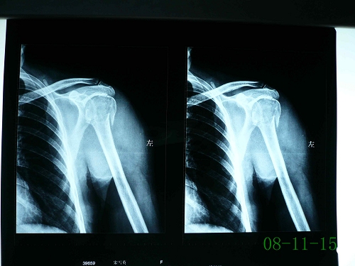 左侧肱骨外科颈骨折图图片