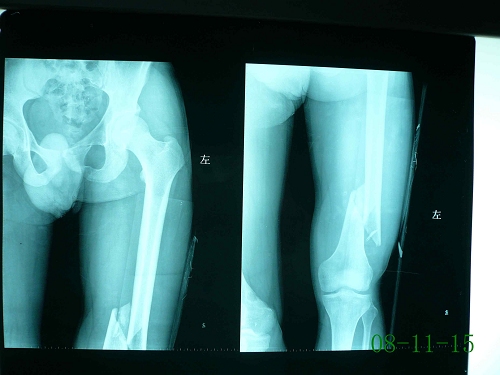 杨某-左股骨干骨折-术前1