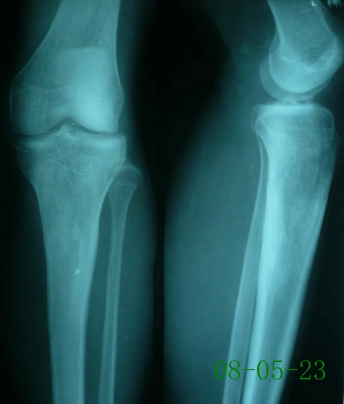 陈某-左胫骨股骨慢性骨髓炎（金葡菌感染）-治疗后