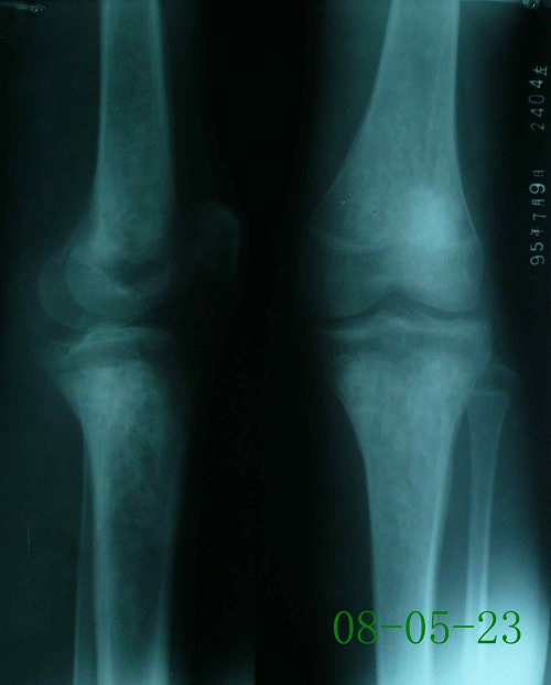陈某-左胫骨股骨慢性骨髓炎（金葡菌感染）-治疗前