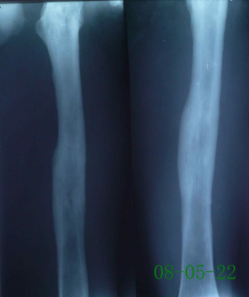 陈某-左股骨慢性骨髓炎伴死骨形成-治疗后