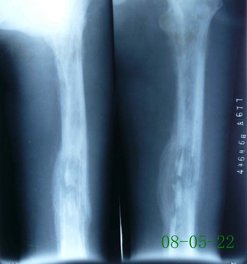 陈某-左股骨慢性骨髓炎伴死骨形成-治疗前