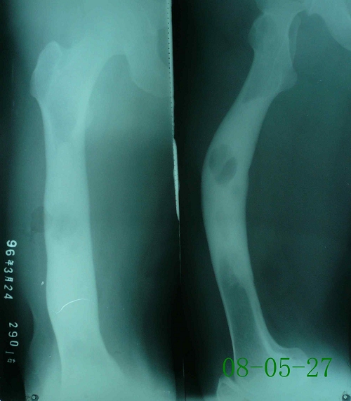 陈某-右股骨慢性硬化性骨髓炎-治疗前