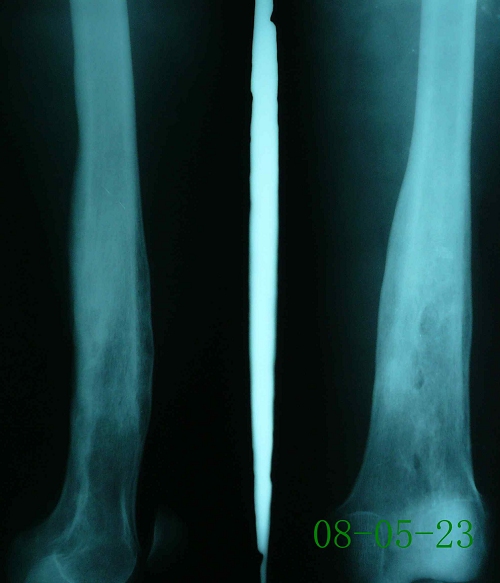 丁某-右股骨下端慢性骨髓炎伴死腔形成-治疗后