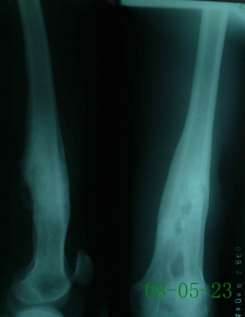 丁某-右股骨下端慢性骨髓炎伴死腔形成-治疗前