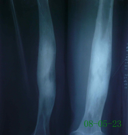 董某-右股骨中段硬化性骨髓炎伴死骨形成-治疗后