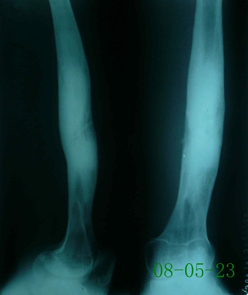 董某-右股骨中段硬化性骨髓炎伴死骨形成-治疗前
