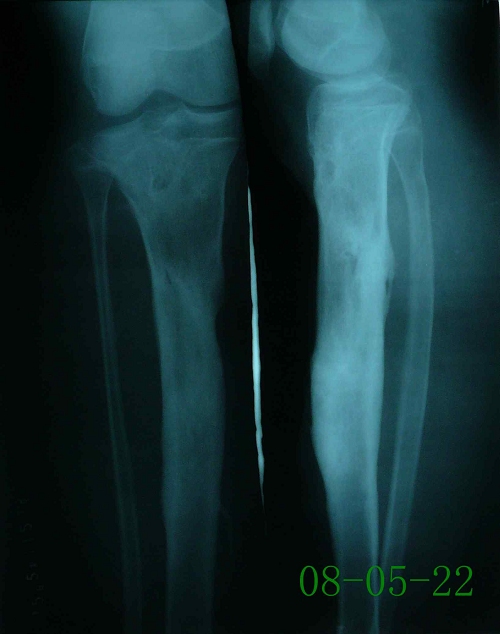 范某-右胫骨慢性骨髓炎伴陈旧性骨折-治疗后