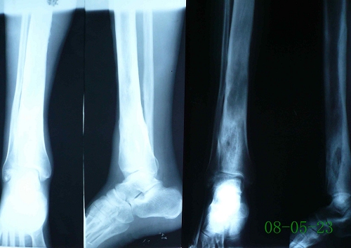 葛某-左胫腓骨硬化性骨髓炎-治疗前后对比