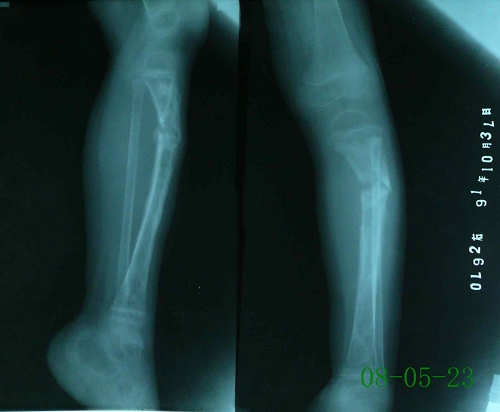 何某-左胫骨慢性化脓性骨髓炎、病理性骨折-治疗前