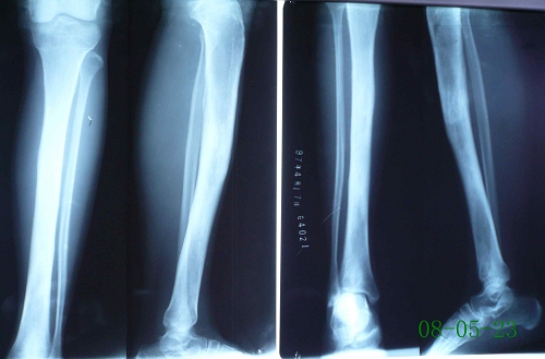 pd_黄芳-右胫骨慢性硬化性骨髓炎-治疗前后对比