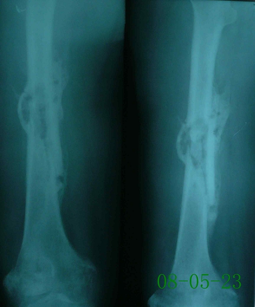 谢某-右股骨慢性骨髓炎、陈旧性骨折伴死骨形成-治疗前