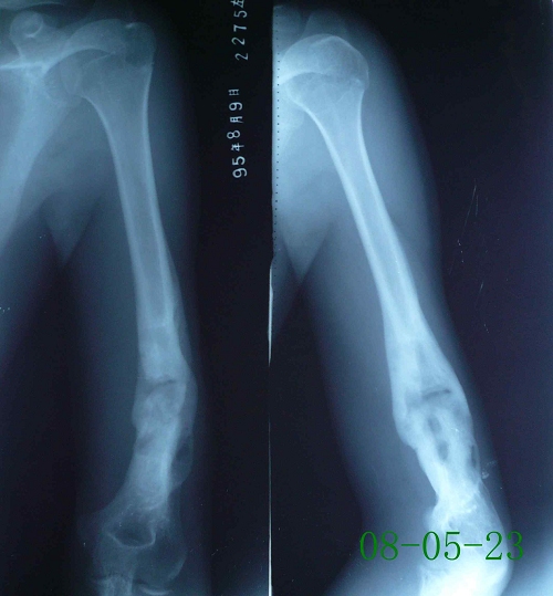 邢某-左肱骨陈旧性粉碎性骨折术后、创伤性骨髓炎-治疗后