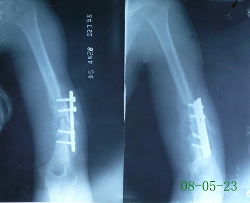 邢某-左肱骨陈旧性粉碎性骨折术后、创伤性骨髓炎-治疗前