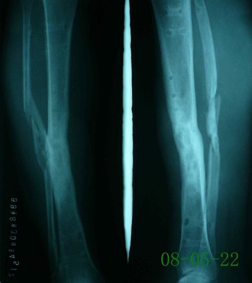 徐某-左腓骨慢性骨髓炎伴陈旧性骨折、骨不连-治疗后