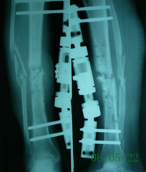 徐某-左腓骨慢性骨髓炎伴陈旧性骨折、骨不连-治疗前