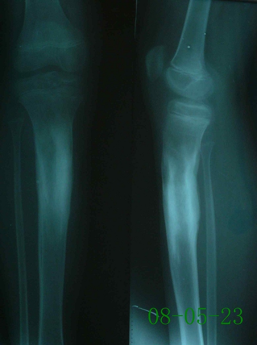徐某-左胫骨上段硬化性骨髓炎-治疗后