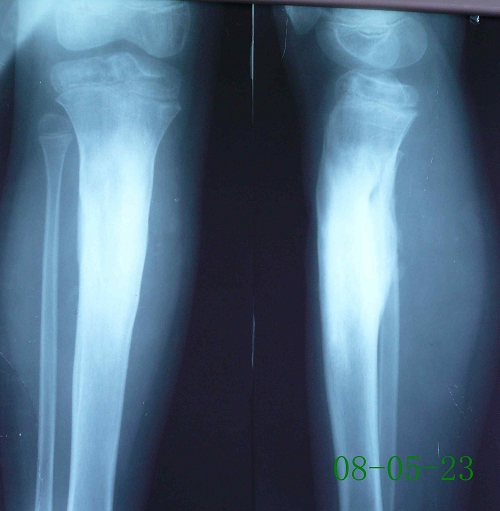 徐某-左胫骨上段硬化性骨髓炎-治疗前
