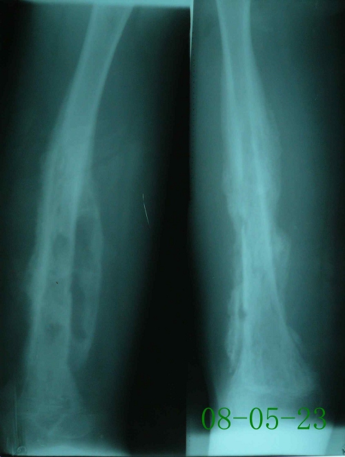 徐某-左股骨慢性血源性骨髓炎-治疗前