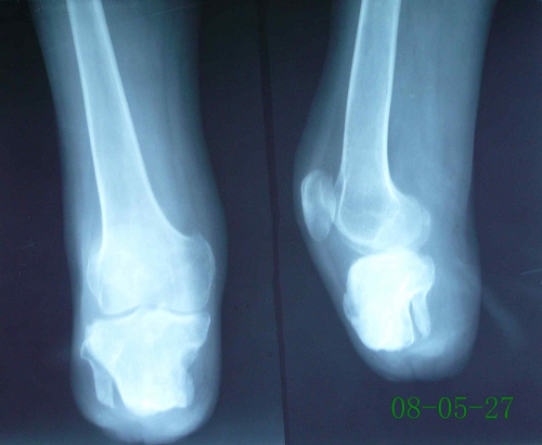 杨某-右小腿截肢术后残端骨髓炎-治疗后