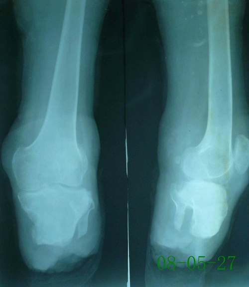 杨某-右小腿截肢术后残端骨髓炎-治疗前