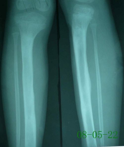 叶某-右胫骨慢性化脓性骨髓炎伴死骨形成-康复后
