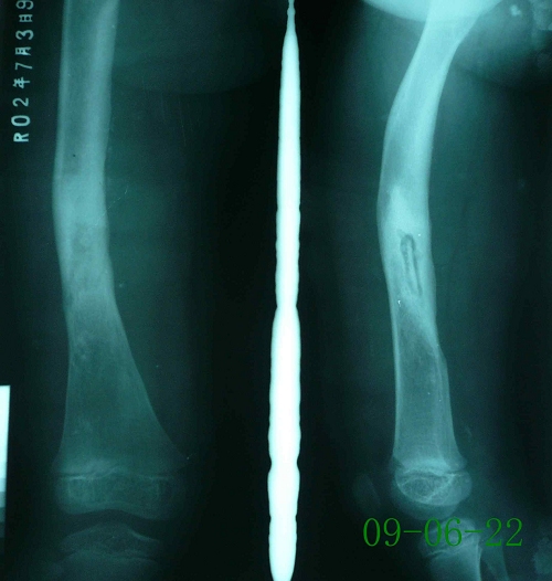 印某-右股骨骨髓炎伴死骨形成-治疗前