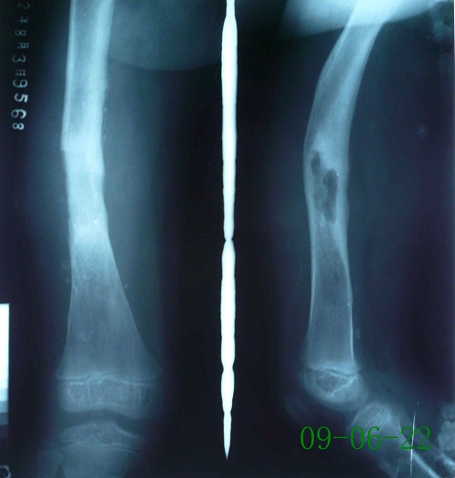 印某-右股骨骨髓炎伴死骨形成-治疗中（死骨吸收）