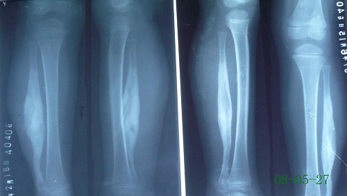 余某-右腓骨慢性骨髓炎伴死骨形成-治疗前后对比