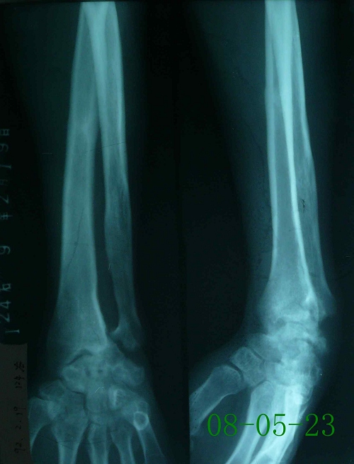 余某-右尺桡骨远端、腕关节骨髓炎-治疗后