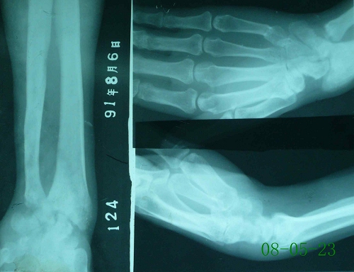 余某-右尺桡骨远端、腕关节骨髓炎-治疗前