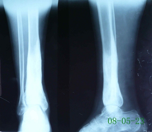 俞某-右胫骨中下段慢性硬化性骨髓炎-治疗前